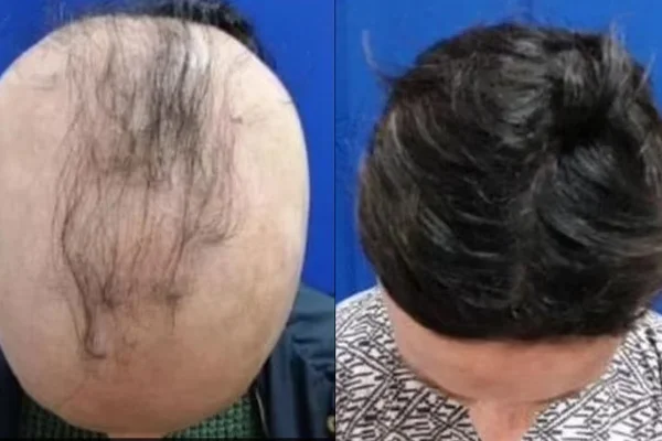 Medicamento recupera cabelos em 40% dos pacientes com alopecia areata