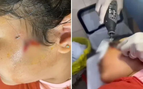 imagem colorida menina de 10 anos fica com anzol preso no rosto durante pescaria em luziânia
