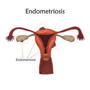 O diagnóstico da doença é clínico, apesar de não ser tão simples detectá-la. Recorrer a exames de imagem é o método mais comum, como a ultrassonografia transvaginal e a ressonância magnética da pelve