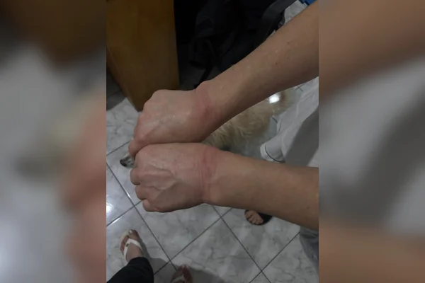 Imagem colorida de marcas de lesão em punhos. Metrópoles
