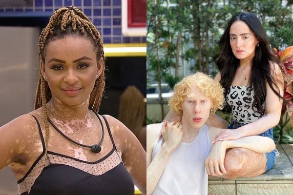 Pessoas com vitiligo e albinismo repudiam falas de Natália no BBB22