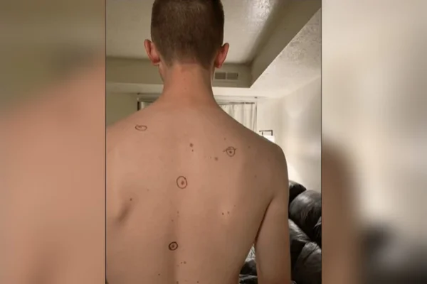 homem de costas com círculos em manchas do corpo