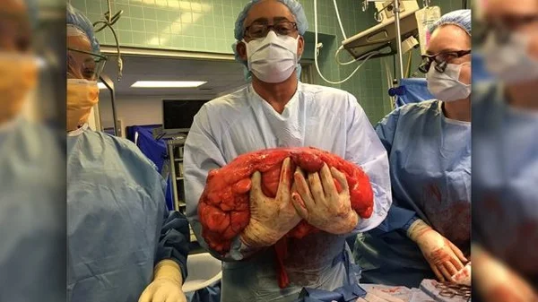 Homem descobre que “barriga de cerveja” era tumor de 13kg