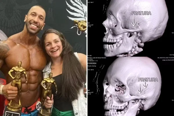 Imagens 3D mostram fraturas de mulher morta por fisiculturista
