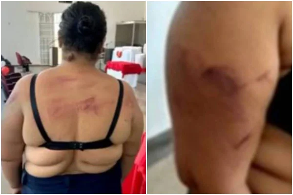 Veja lesões de mulher agredida com facão com bebê no colo pelo companheiro