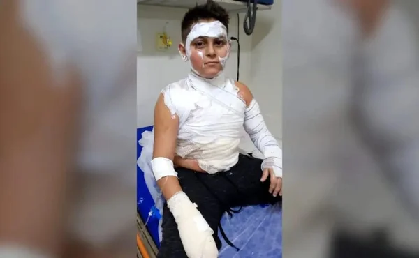 Menino sofre várias queimaduras após mangueira de fogão explodir no PR