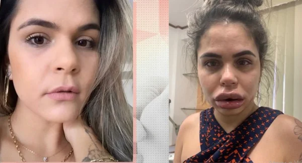 Mulheres acusam dentista de deformar rostos após harmonização facial