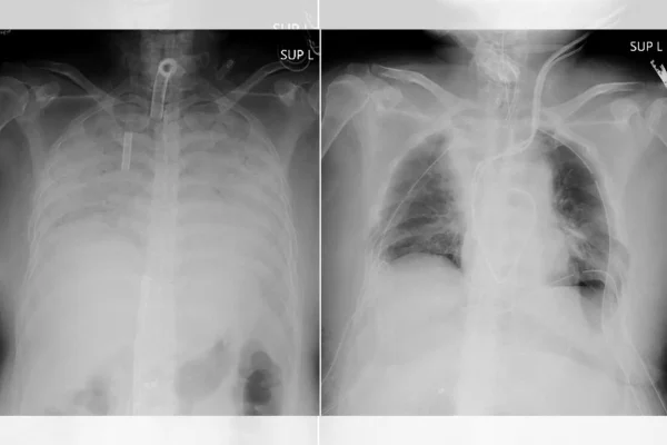 Pulmão transplantado