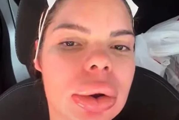 Nutricionista sofre reação alérgica grave após preenchimento labial
