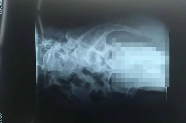 Jovem coloca objeto inusitado no pênis e tem que passar por cirurgia