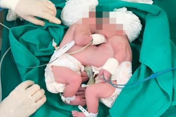 Mãe de 18 anos dá à luz a gêmeas siamesas na Bahia