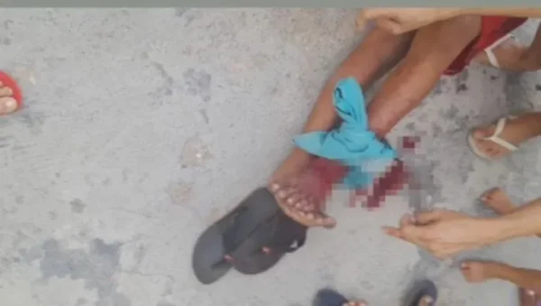 Imagem colorida da do ferimento feito pelo jacaré na criança