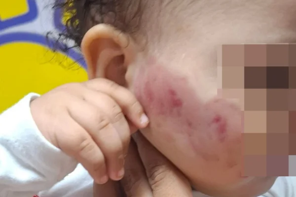 Imagem colorida de bebê com marca de mordida no rosto. Metrópoles