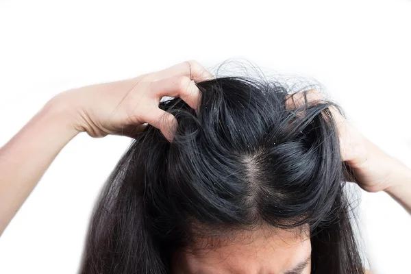 Conheça produtos e dicas para tratar a caspa, agravada no inverno