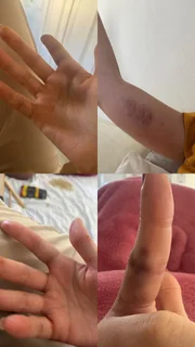 Amiga mostrou os machucados e hematomas de Marcela Tomaszewski Amiga mostrou os machucados e hematomas de Marcela Tomaszewski