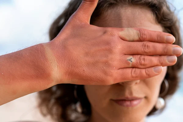 Foto colorida de com o braço todo marcado por queimaduras de sol, sintomas de insolação - Metrópoles.