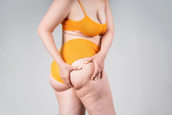 Foto colorida de mulher mostrando a celulite do bumbum - Metrópoles