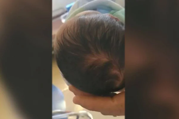 Criança com hematoma na cabeça