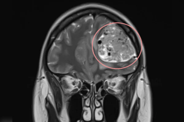 Foto de uma ressonância magnética que mostra um tumor cerebral - Metrópoles.