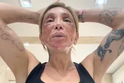 Maya Massafera choca ao aparecer com rosto ferido após peeling
