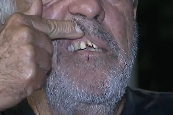 Idoso mostra dente quebrado por PMs do DF