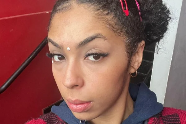 Mulher em tratamento por alopecia de tração- Metrópoles