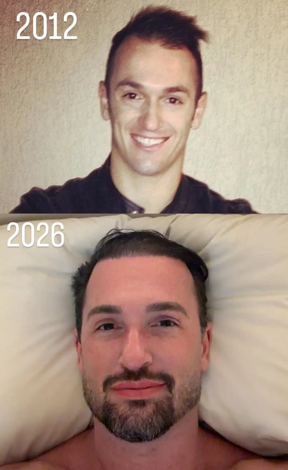 Antes e depois: Diego Hypolito mostra mudanças após procedimentos estéticos Antes e depois: Diego Hypolito mostra mudanças após procedimentos estéticos