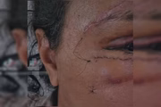 Foto que mostra lesões no rosto de uma mulher agredida com 61 socos pelo ex