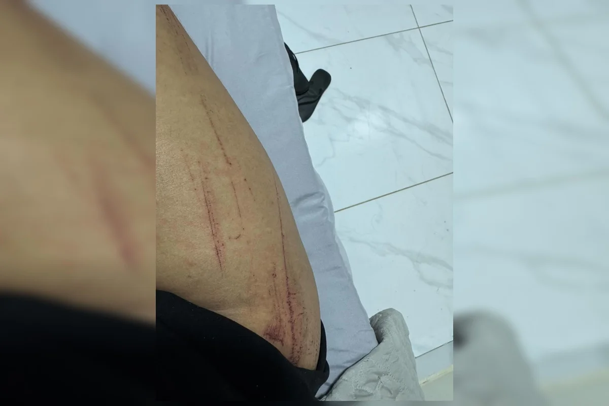 Fotografia mostra lesões sofridas por uma das jovens após o crime que terminou com a prisão do suspeito Fotografia mostra lesões sofridas por uma das jovens após o crime que terminou com a prisão do suspeito