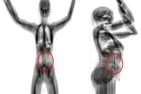 Imagem preto e branca de scan de mulher - Metrópoles