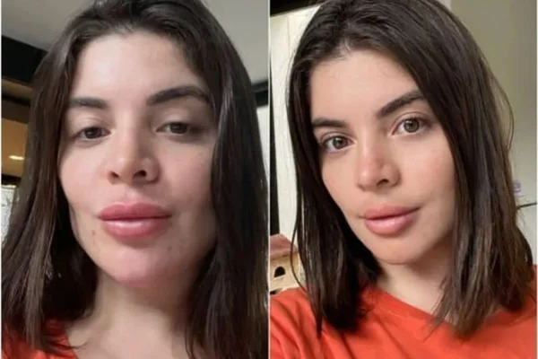 Gkay reverteu procedimentos estéticos quando percebeu que não conseguia ver o próprio sorriso de tanto preenchimento que tinha na boca - Metrópoles