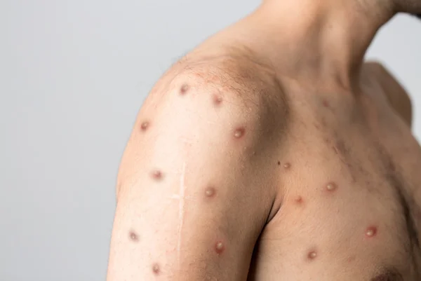 Homem de perfil com feridas da mpox rio de janeiro - Metrópoles