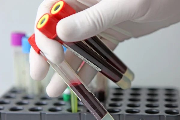 Foto em close up de uma mão com luvas segurando 3 frascos com sangue. Metrópoles