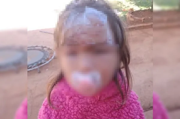 menina ferida por ataque de cão