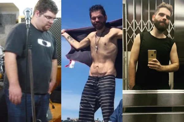 Foto mostra Nando Castros, homem branco de barba, que fez cirurgia bariátrica e teve estenose - Metrópoles