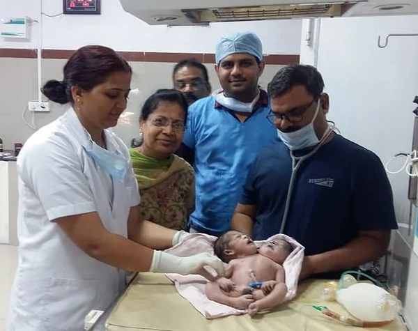 Siameses indianos: entenda rara condição de gêmeos em um só corpo
