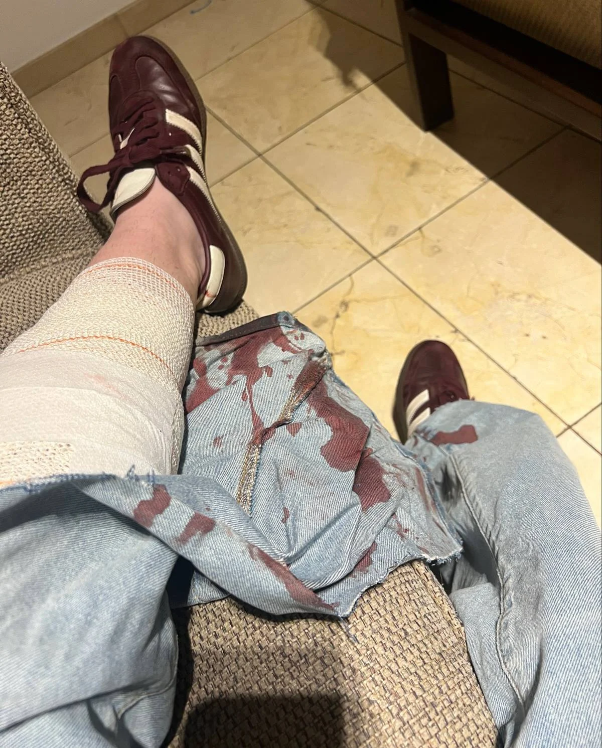 Ela precisou levar 30 pontos na perna e quase teve uma fratura exposta devido ao acidente Ela precisou levar 30 pontos na perna e quase teve uma fratura exposta devido ao acidente