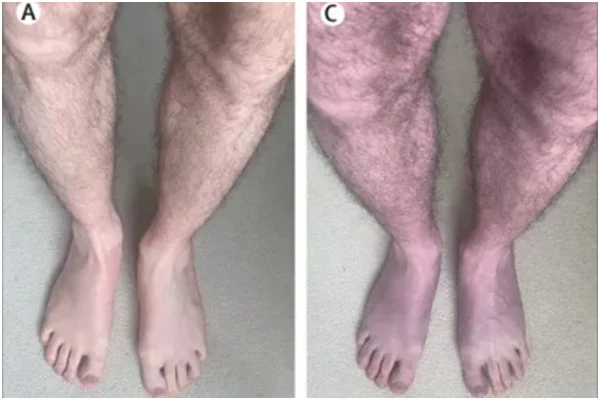 Duas fotos de pernas de homem com cores diferentes - Metrópoles