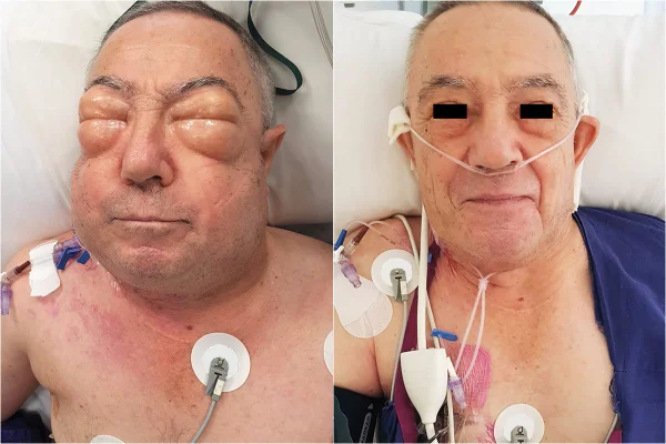 Paciente com doença pulmonar fica com rosto inchado