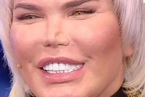 Ken Humano está prestes a perder o nariz após a 11ª rinoplastia