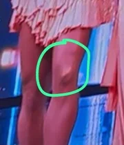 Gracyanne Barbosa mostrou como ficou seu joelho após o acidente no palco do Domingão 