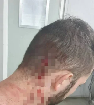 Machucado na cabeça de homem agredido por policial penal na Barra da Tijuca, zona oeste do Rio de Janeiro