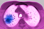 O câncer de pulmão é um dos tipos com maior incidência no Brasil. Relacionado ao uso ou exposição prolongada ao tabagismo, tem como principais sintomas a falta de ar, dores no peito, pneumonia recorrente, bronquite, escarro com sangue e tosse frequente. A doença é tratada com quimioterapia, radioterapia ou/e cirurgia
