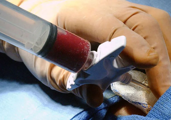 Paciente americana é curada do HIV após transplante de células-tronco
