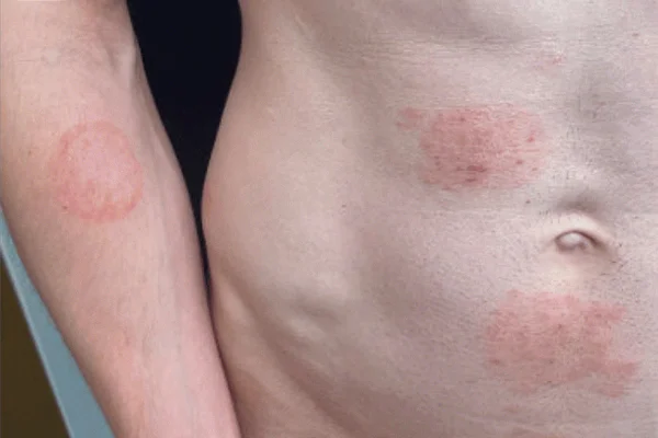 Foto colorida de homem com lesões de micose provocada por superfungo no corpo - Metrópoles