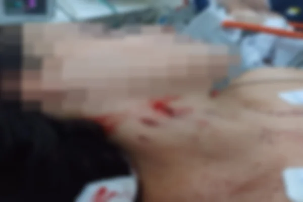 Ela foi atingida na região do pescoço e na coxa direita