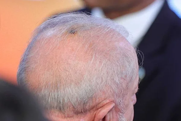 Foto colorida de couro cabeludo de Lula - Queratose: entenda tudo sobre o diagnóstico de Lula - Metrópoles