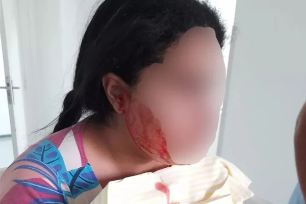 Jovem foi internada com sangramentos na boca, ouvido e nariz