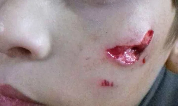 Criança de seis anos sofre grave ferimento em escola do DF