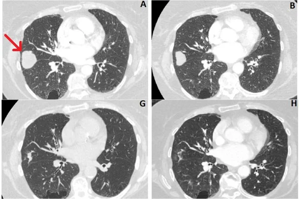 Tumor cerebral - tratamento com canabidiol